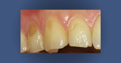 Odontoiatria Estetica - Erosione al Colletto di alcuni denti
