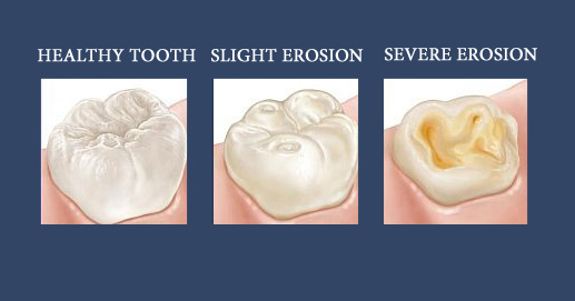 Example of dental erosion