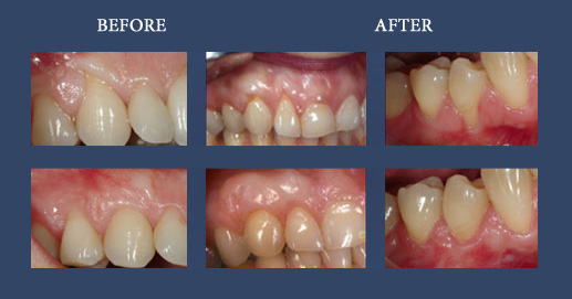 Resolution of some cases of gingival regression