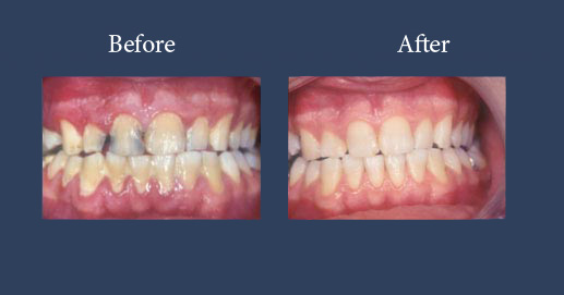 Oral Hygiene and aesthetic composite fillings