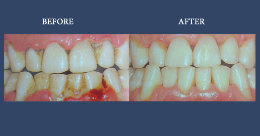 Oral Hygiene and aesthetic composite fillings