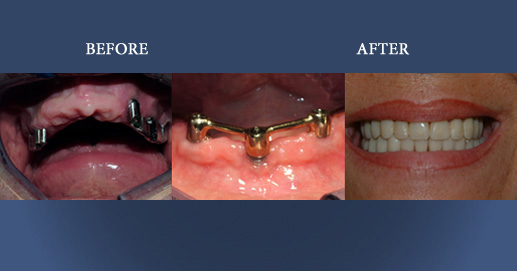 Upper and lower mobile dentures supported by dental implants