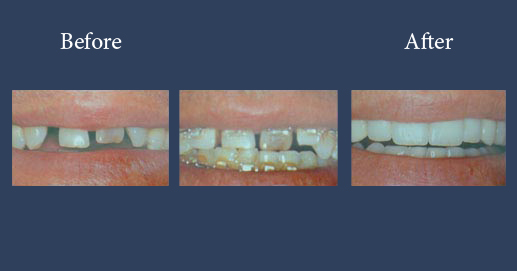 Targeted orthodontic case with lumineers