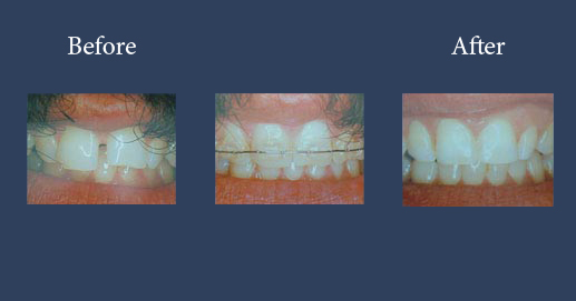 Orthodontics with cosmetic add-ons