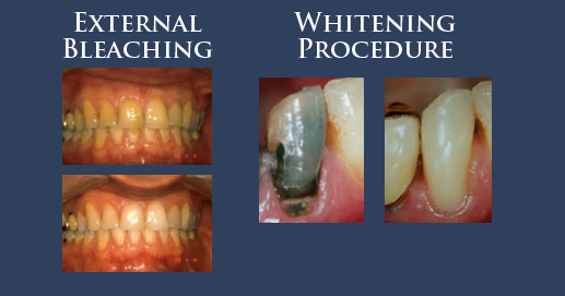 Various moments of teeth whitening