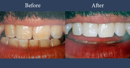 Various moments of teeth whitening