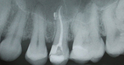 Odontoiatria - Trattamento Endodontico