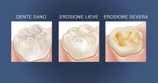 Odontoiatria Estetica - Esempio di erosione dentale