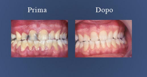 Odontoiatria - Igiene Orale e Otturazioni estetiche in composito