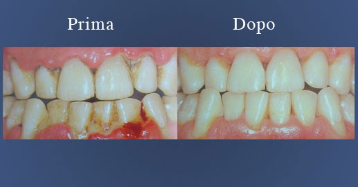 Odontoiatria - Igiene Orale e Otturazioni estetiche in composito
