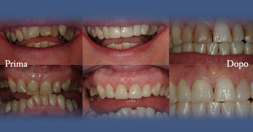 Odontoiatria Estetica - Riabilitazione con Faccette Estetiche