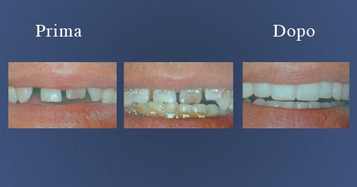 Odontoiatria - Caso ortodontico finalizzato con faccette