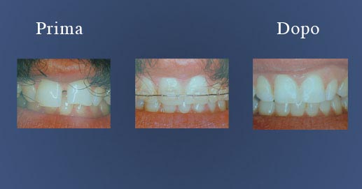 Odontoiatria - Ortodonzia con attacchi estetici