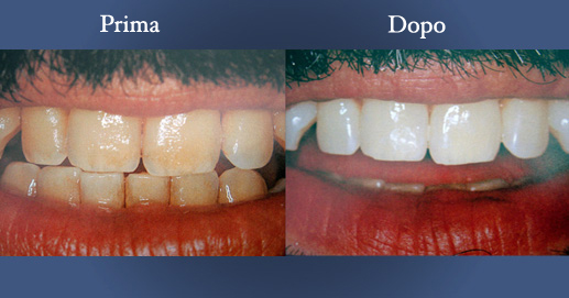 Odontoiatria Estetica - Vari momenti dello sbiancamento dentale