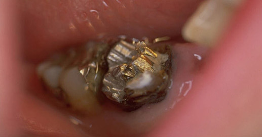 Эффект коррозии зубов удаляется с помощью амальгамы