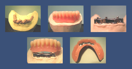 Removable dentures on bar and ball implants for retention 