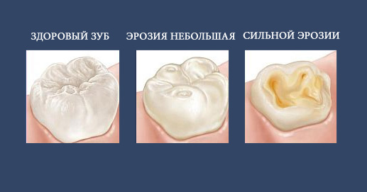 Пример зубной эрозии
