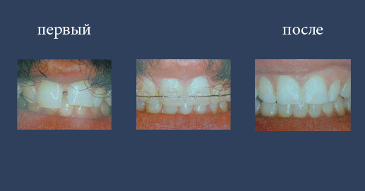 Ортодонтия по эстетическому выравниванию зубов