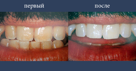  Различная степень отбеливания зубов